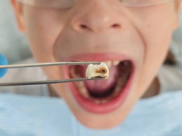 Best Emergency Tooth Extraction in Independence, MO