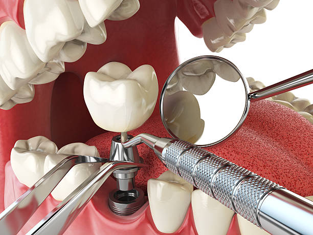 Best Emergency Treatment for Dental Infections or Abscesses in Independence, MO